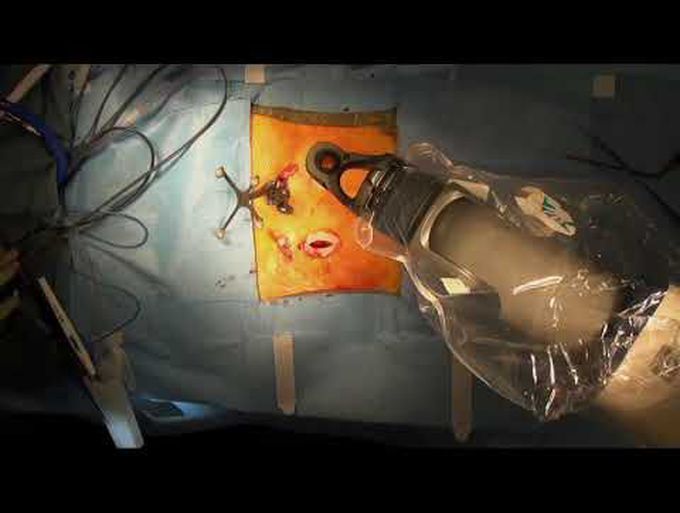 Integrating robotics into a minimally invasive transforaminal interbody fusion workflow