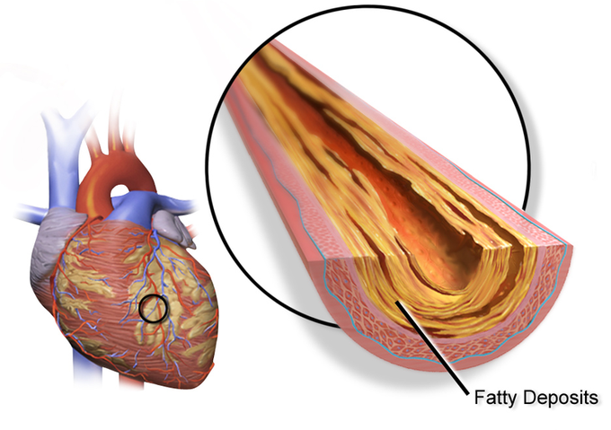 Symptoms of coronary artery diseases