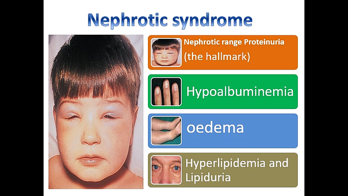 Nephrotic syndrome