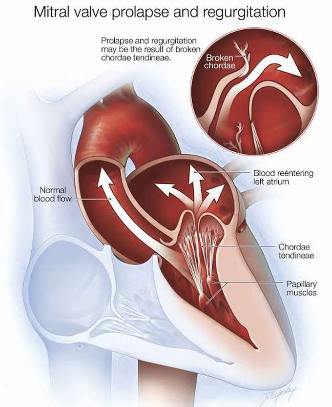 Mitral regurgitation causes