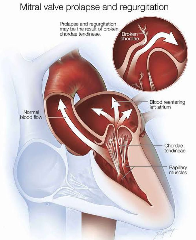 Mitral Regurgitation Causes MEDizzy