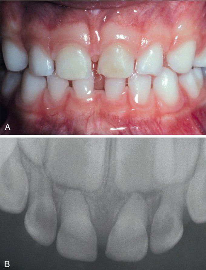 Calcific Metamorphosis.