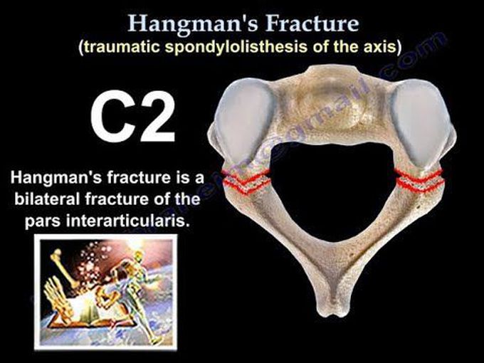 Hangman’s Fracture: