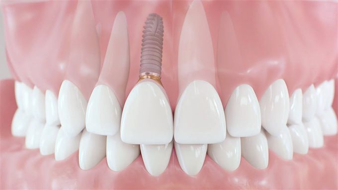 Dental Implant Procedure-Made easy