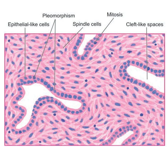 Synovial sarcoma