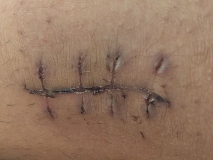 Deep incised stitches