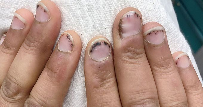 Splinter hemorrhages