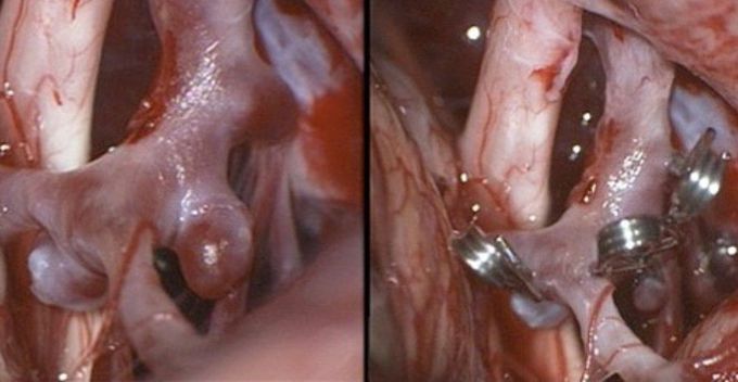 Surgical Clipping Of Brain Aneurysms