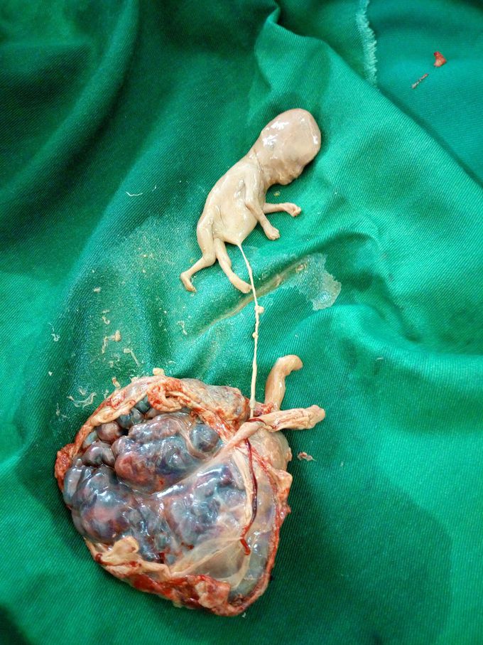 Partial molar pregnancy