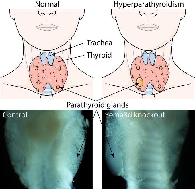 Hyperparathyroidism