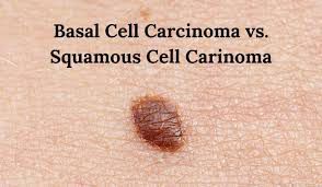 What is basal cell carcinoma - MEDizzy