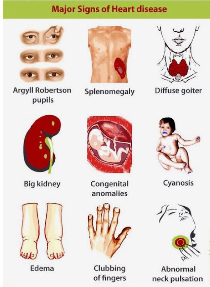 Sign of heart disease