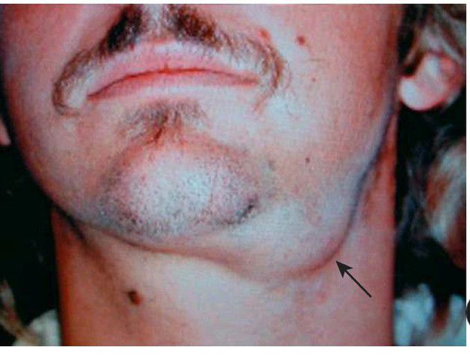 Sialolithiasis