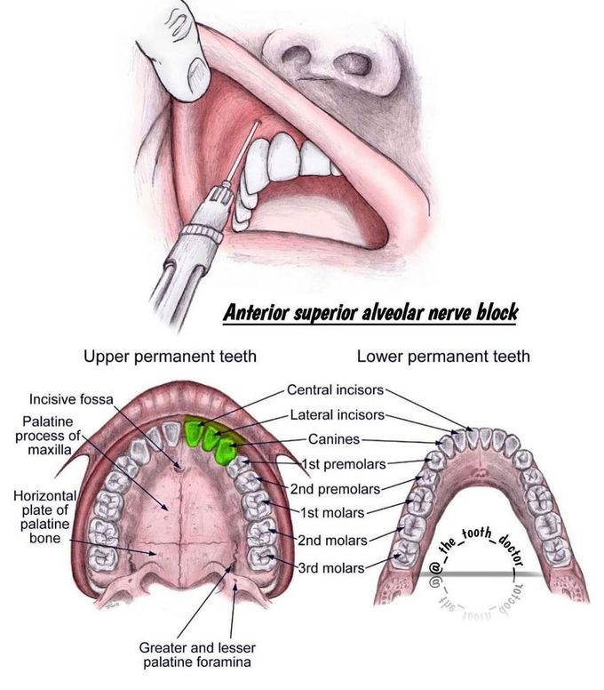 Anterior Superior Alveolar Nerve Block