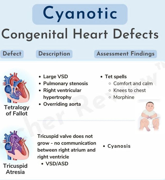 Cynotic Congenital Heart Defect