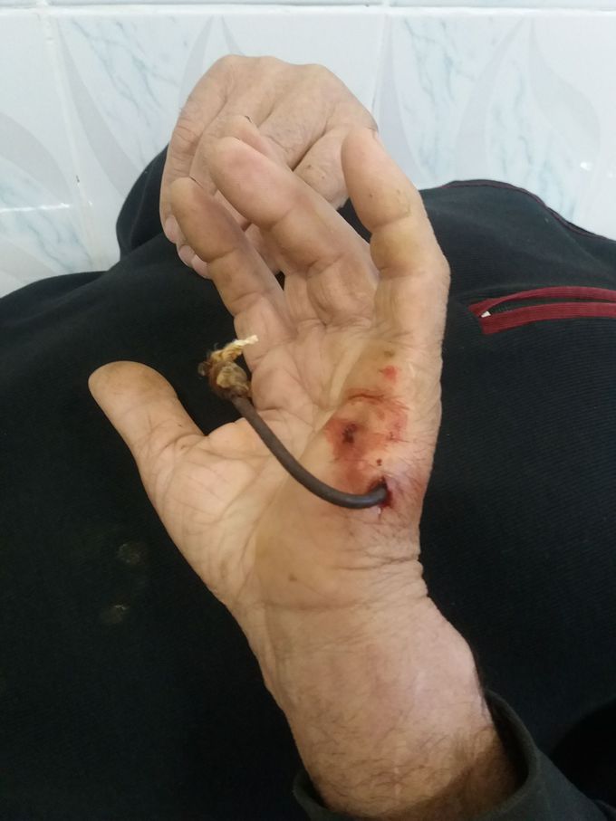 Injure of hand