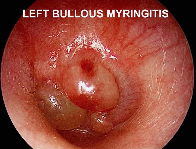 Bullous Myringitis