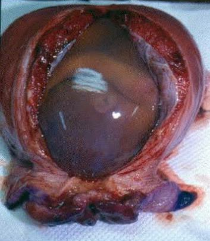 Hysterectomy with foetus-in-situ