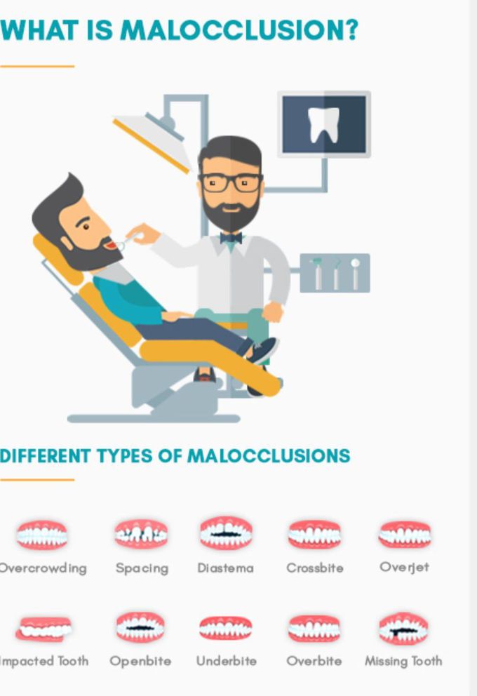 Angle's Classification of Occlusion - MEDizzy