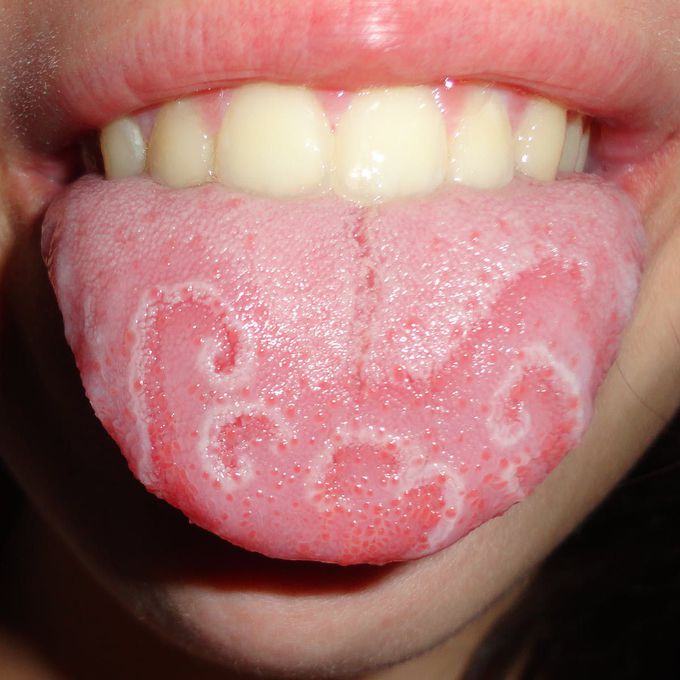 Geographic Tongue