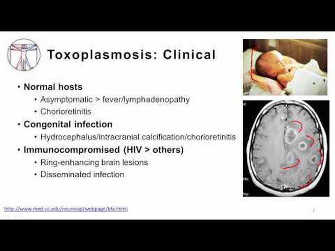 Cerebral Toxoplasmosis