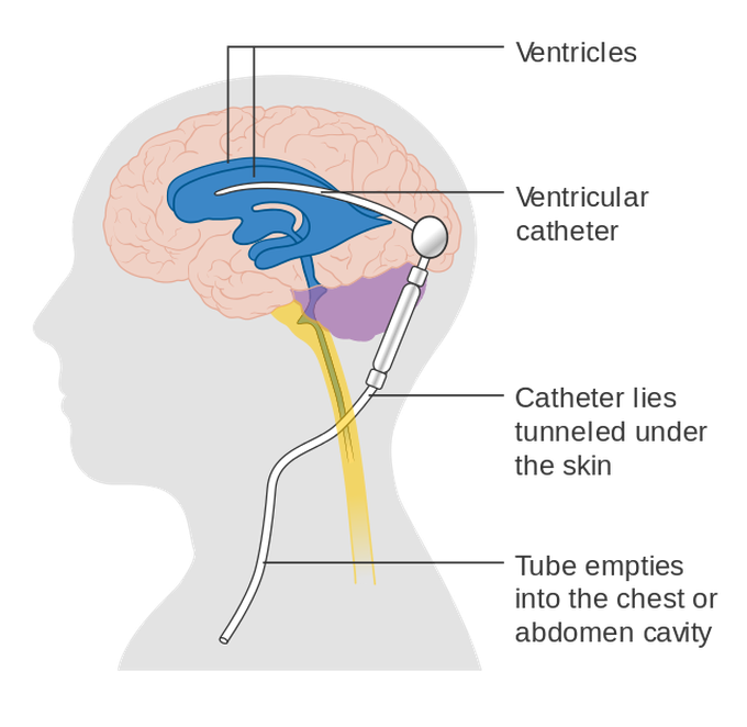 Cerebral Shunt