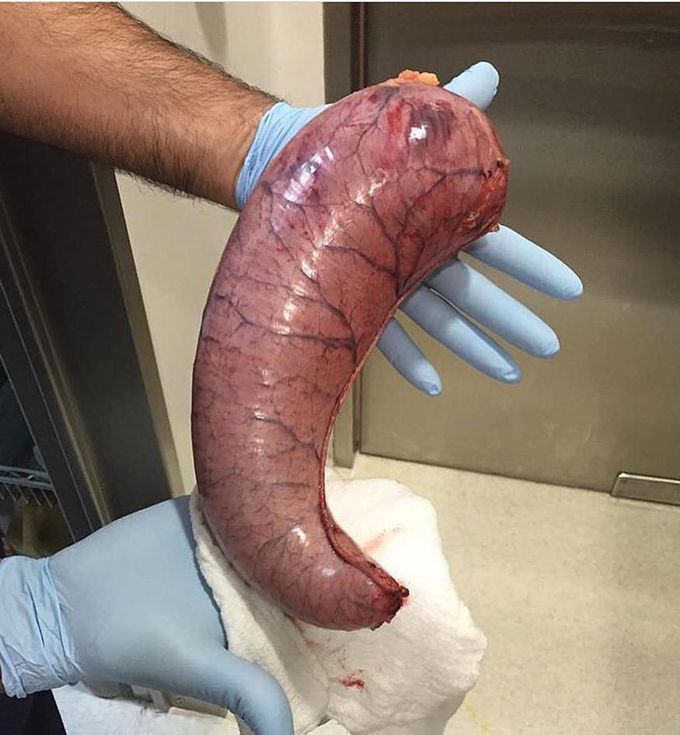 Sleeve Gastrectomy!! 