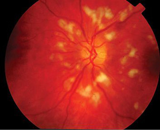 Cotton Wool Spots in Diabetic Neuropathy