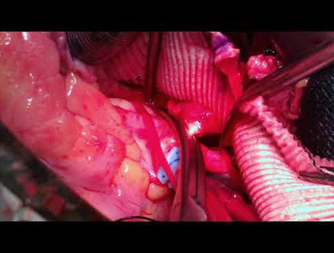 Repair of Aortic Graft Aneurysm After Extra-Anatomic Aorto-Aortic Bypass for Interrupted Aortic Arch