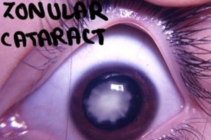 Zonular Cataract