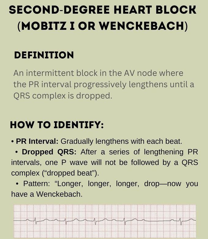 Second Degree Heart Block