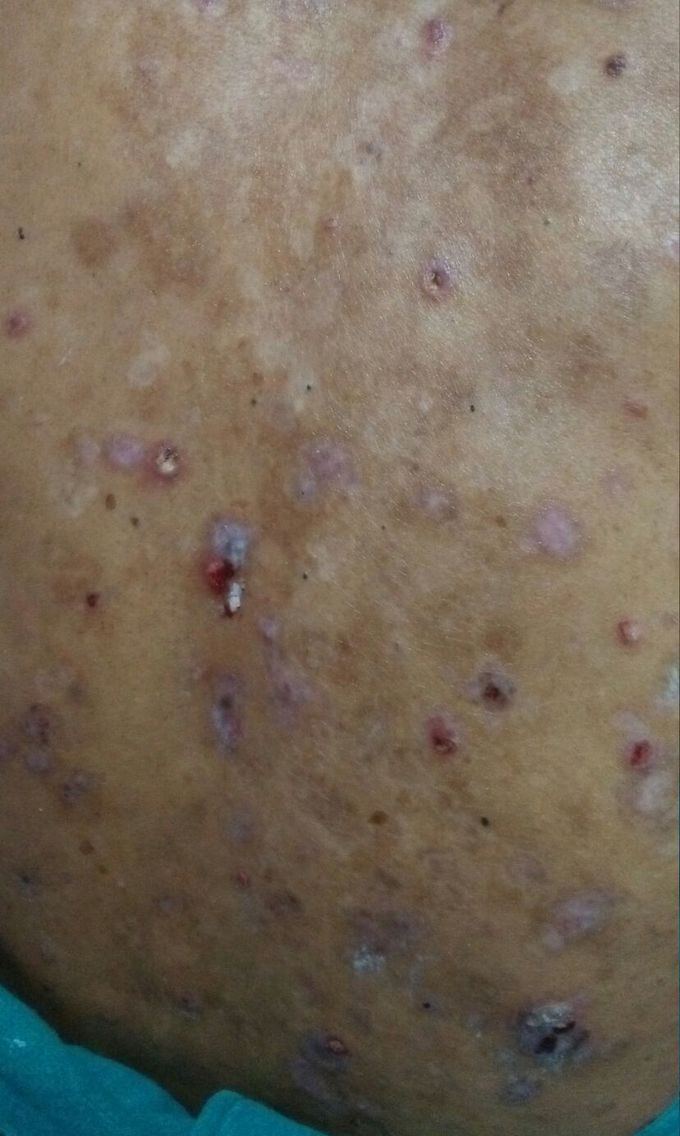 Bullous Pemphigoid