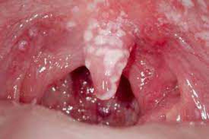 Management of Oral Candidiasis