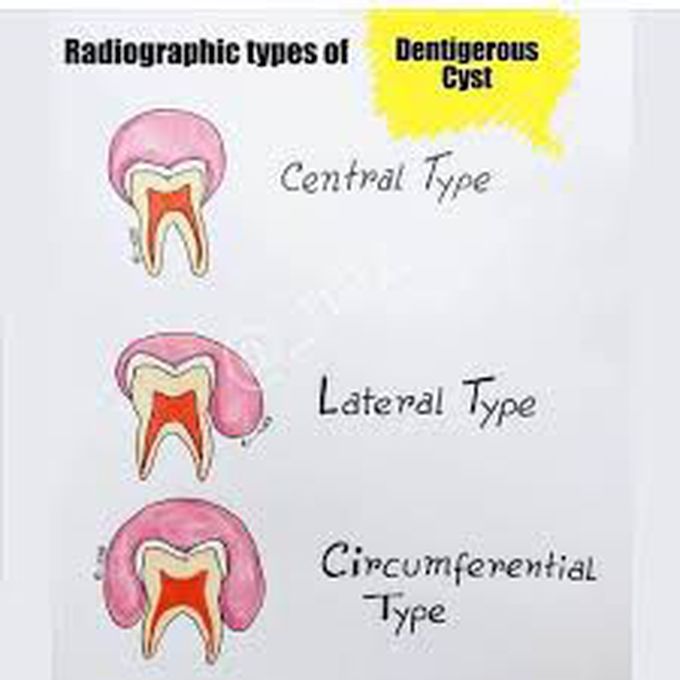 Dentigerous Cyst