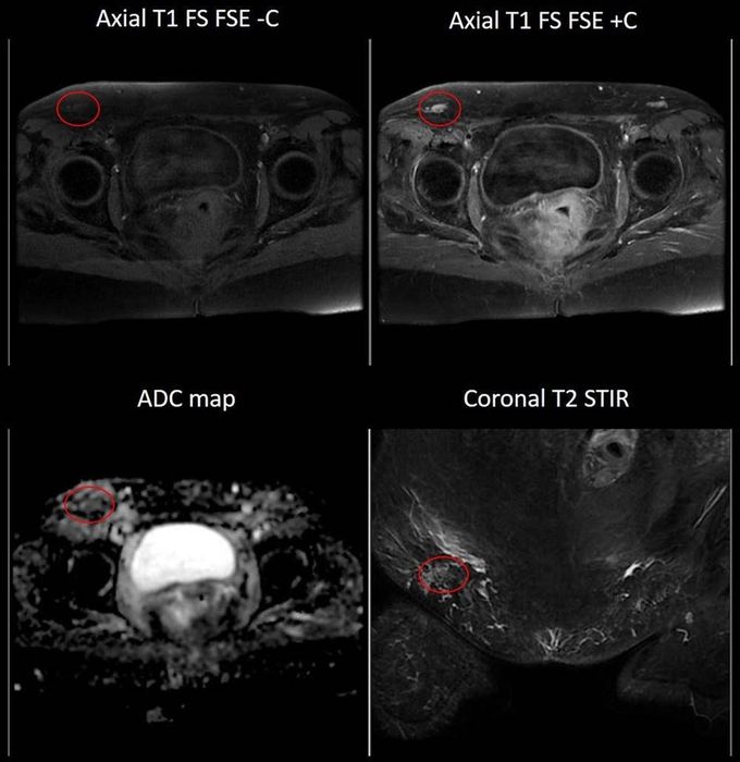 MR Imaging of the pelvis