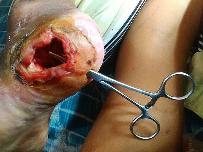 Hole in the foot
