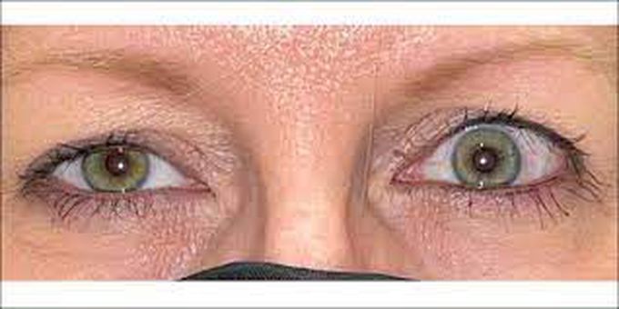 What are the symptoms of ptosis?