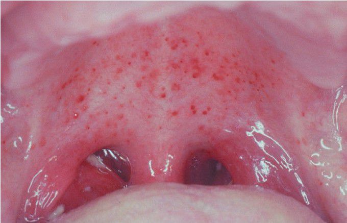 Infectious Mononucleosis.