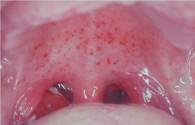 Infectious Mononucleosis.