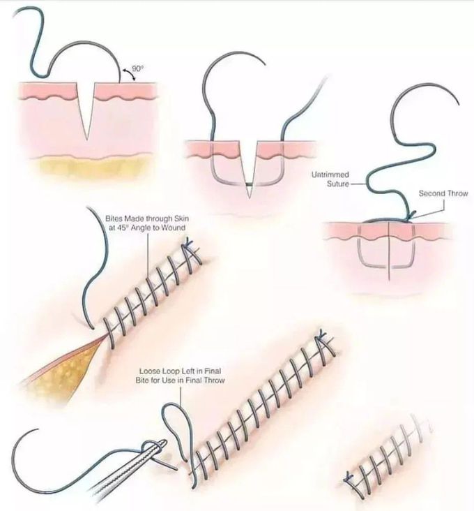 Suture Technique