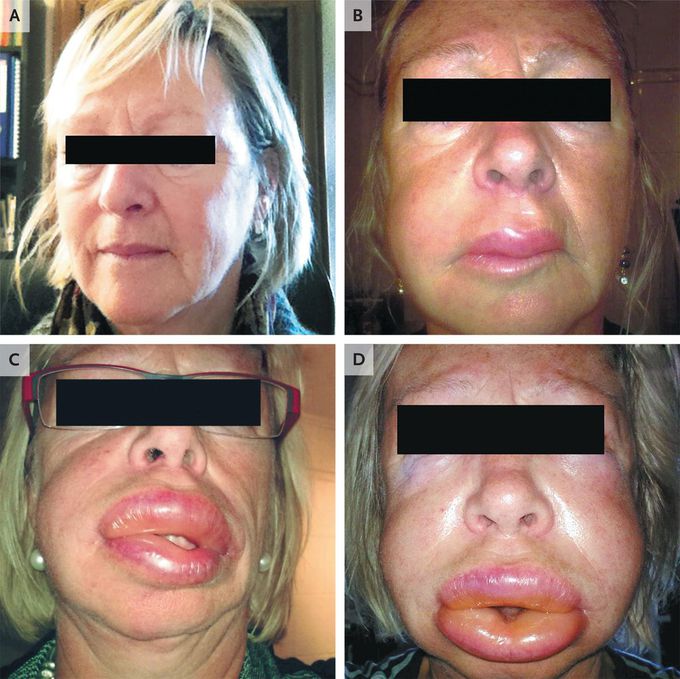 Disfiguring Angioedema