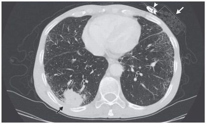 Lung cancer