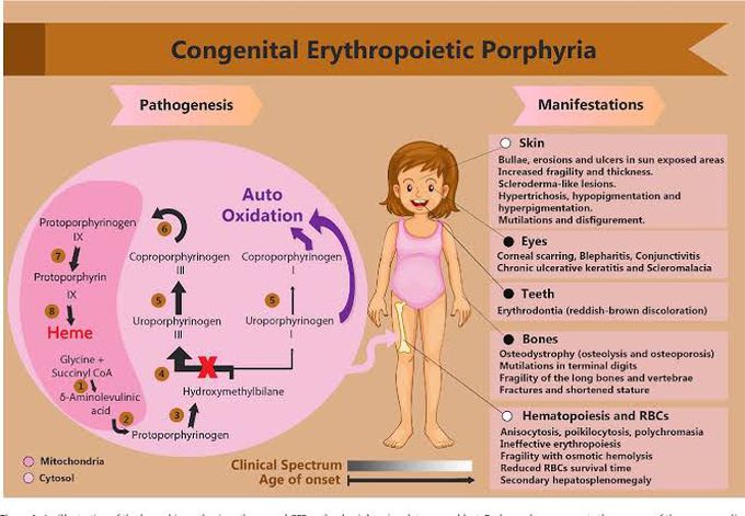 Congenital Erythropoietic Porphyria