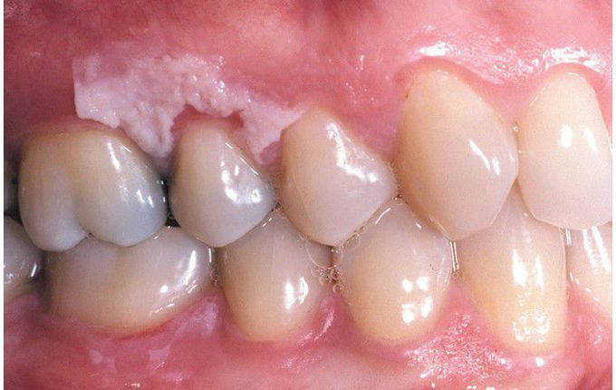 Mucosal Burn from Tooth-whitening Strips