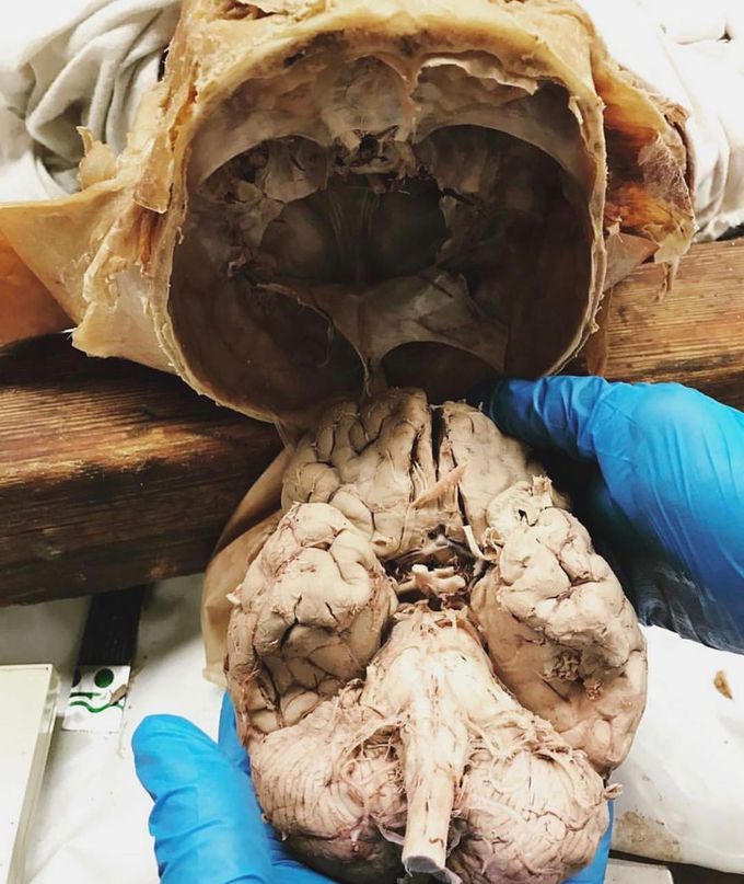 Human central nervous system beautifully dissected