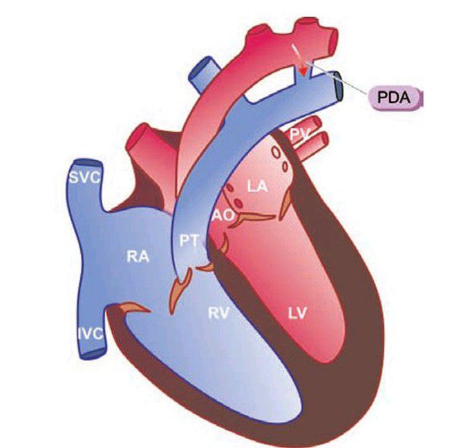 Patent ductus arteriosus