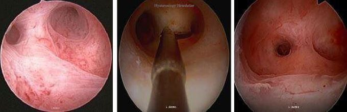 Hysteroscopy.info