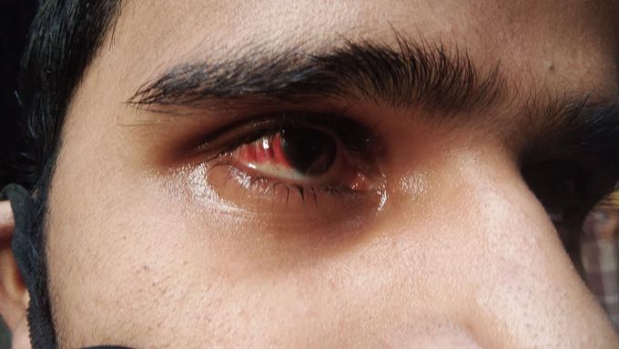25 year old male patient. 10 days before history of entering some objects in to eyes and he doesn’t have pain just blood inside eyes.