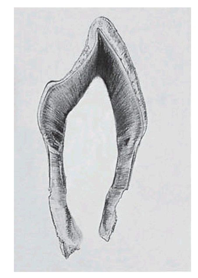Dental anomalies in hypophosphatasia