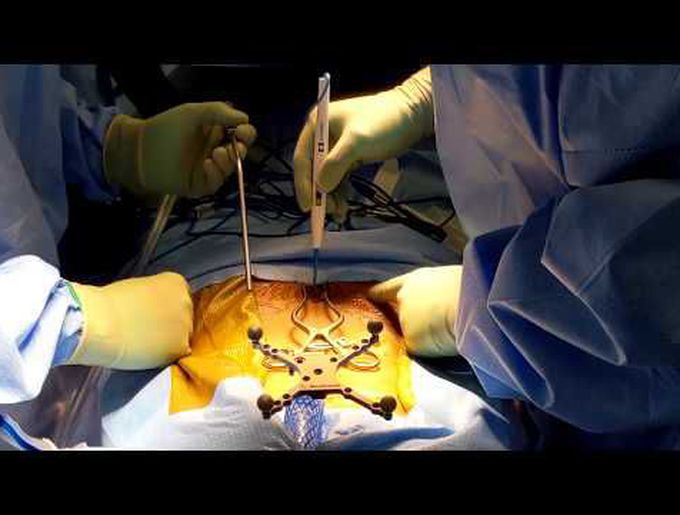 Closure of L3 pedicle subtraction osteotomy via an open-bottom hinged table in 3D video